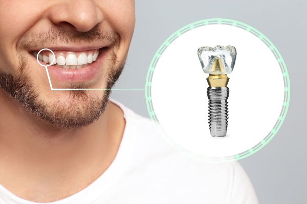 Signs You May Need A Dental Implant