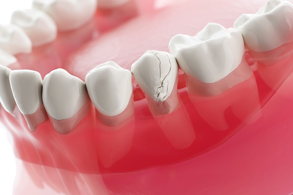 Get A Broken Tooth Treated To Avoid Complications