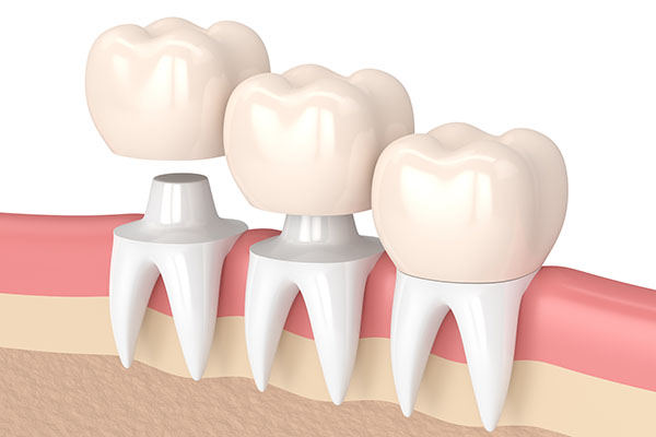 Choose CEREC Ceramic Crowns Over Other Traditional Crown Materials