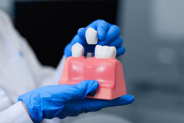 Dental Implant Restoration Procedures For Tooth Loss