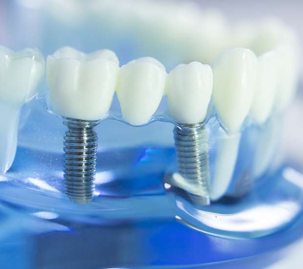 Trophy Club Dental Implants