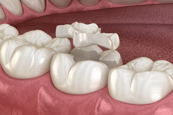 Common Reasons To Get A Dental Inlay