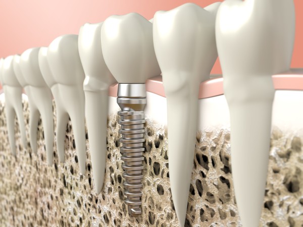 Reasons To Choose Trophy Smile Studio For The All On   Tooth Replacement Procedure