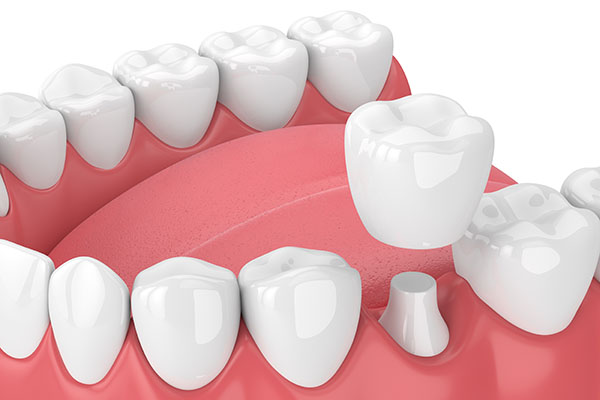 How a CEREC Restoration Can Help a Damaged Tooth from Trophy Smile Studio in Trophy Club, TX