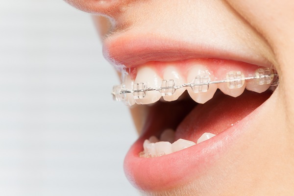 Options For Adult Invisible Braces