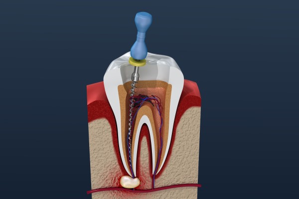 Root Canal Treatment Trophy Club, TX