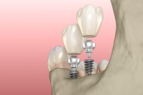 Temporary Teeth In A Day While You Heal After Dental Implant Surgery