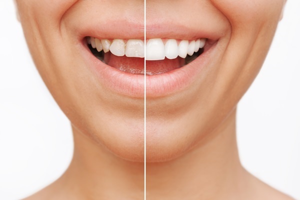 What To Discuss At A Smile Makeover Consultation